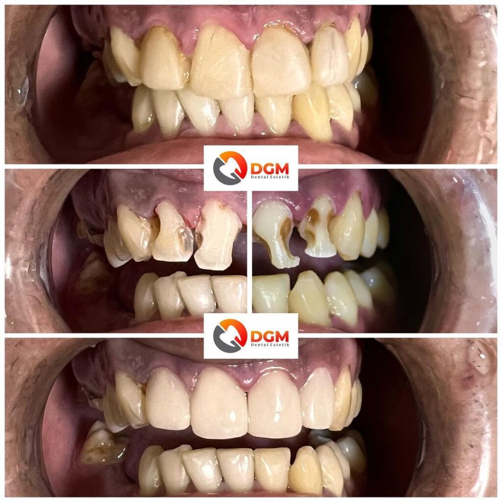 Crown & Veneer Direct