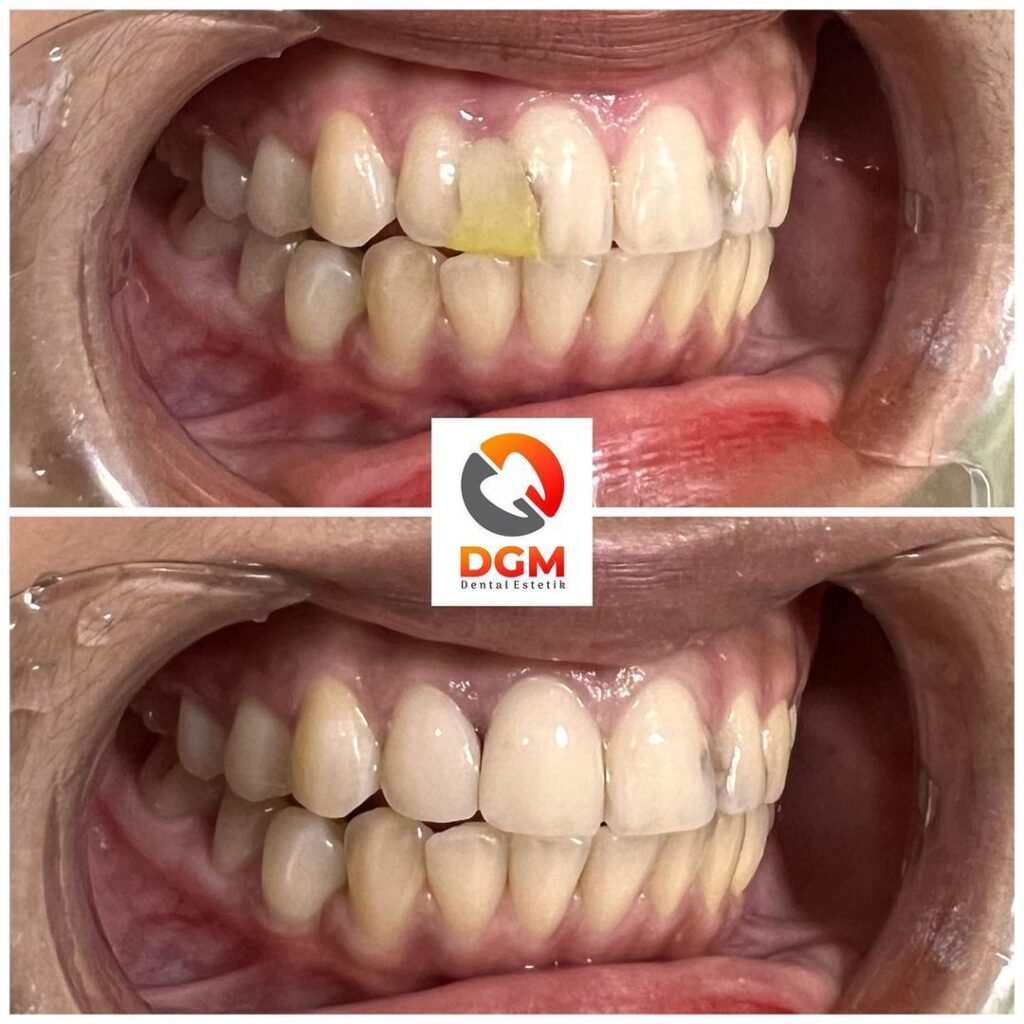 Veneer Direct