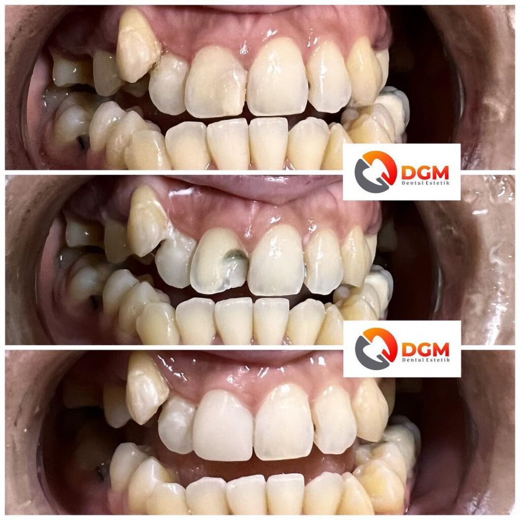Veneer Direct