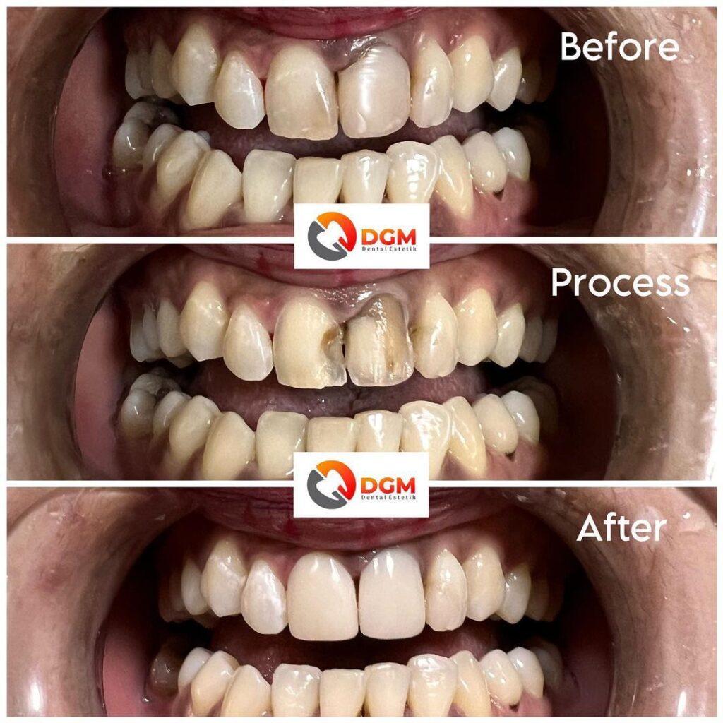 Veneer Direct