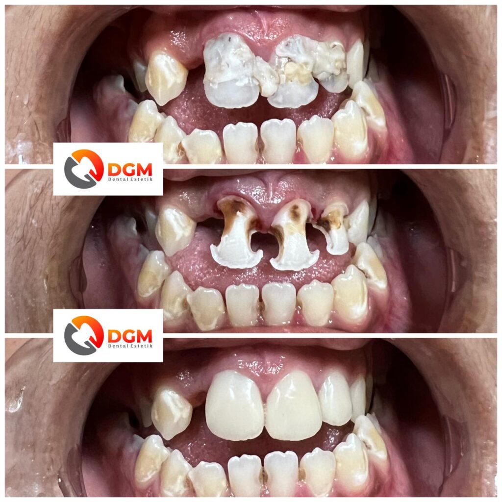 Veneer Direct